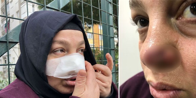 Spor yaparken pitbull saldırısında burnundan yaralandı