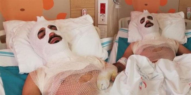 Isınmak için tenekeye tiner atınca elleri ve yüzü yandı