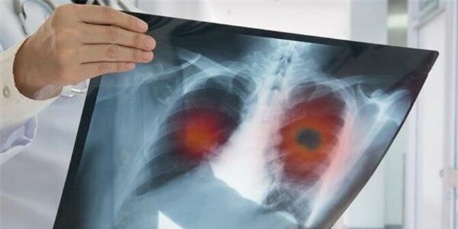 Trkiye'de her yl yaklak 160 bin kii kalp hastalklarndan lyor