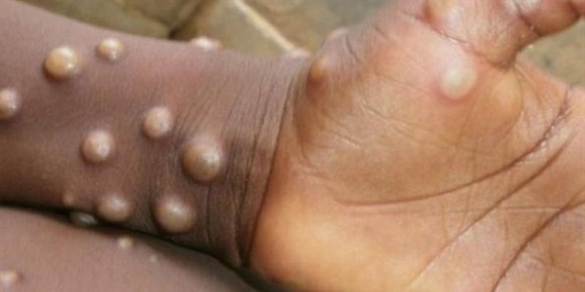 Monkeypox alarmı! Yeni bir salgın tehdidi mi?