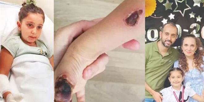 İstanbul'da MR çektikleri 7 yaşındaki Elif'i yaktılar!