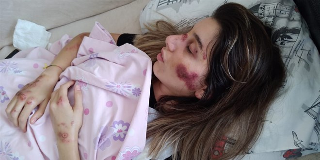 Yaralanan skuter sürücüsü hemşire taburcu edildi