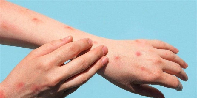 Bakan Koca aklad: Trkiye'de maymun iei vakalar ykseldi