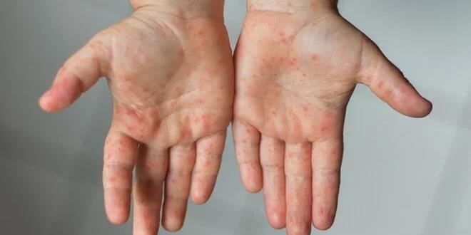 Kızamık salgını mı var? İstanbul'da 2 çocuk hayatını kaybetti