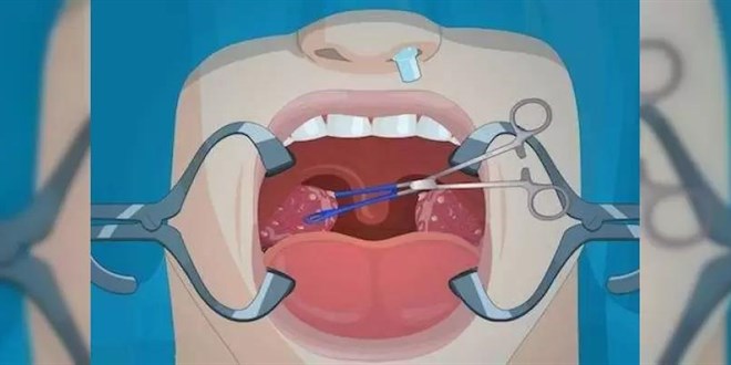 Bademcik ameliyat sonras engelli kald! 39 milyon liralk rekor tazminat talebi