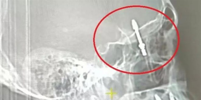 İmplant tedavisinde vida beynine saplandı