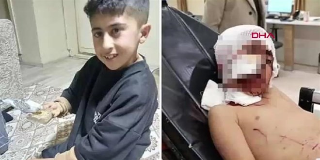 Sokak Köpekleri Erzurum'da 10 Yaşındaki Çocuğa Saldırdı