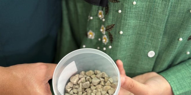 Doktorlar bile �ok oldu! V�cudundan 287 tane ta� ��kar�ld�