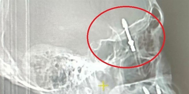 2 yıldır adalet bekliyor! Beynine saplanan implant hayatını kararttı - Son Dakika Haber