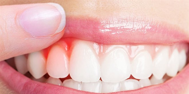 Di� Eti �ekilmesi: Sessiz �lerleyen Ama Ciddiye Al�nmas� Gereken Bir Sorun