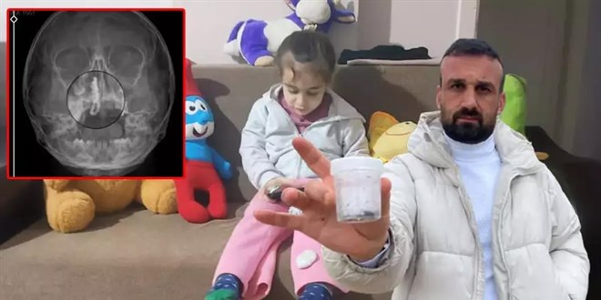 5 ya��ndaki �ocu�un burnundan t�rnak makas� zinciri ��kt� - Son Dakika Haber