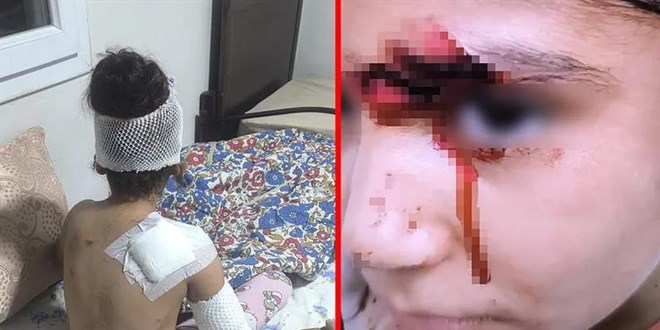 Ba��bo� k�peklerin sald�rd��� 8 ya��ndaki �ocu�a 150 diki� at�ld� - Son Dakika Haber