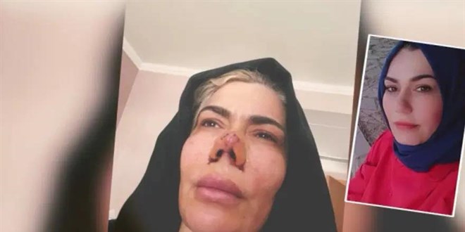 4 y�lda 4 burun ameliyat� ge�irdi, her seferinde burnu daha k�t� oldu - Son Dakika Haber