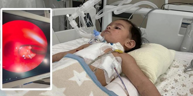 Konya'da 1 ya��ndaki bebe�in akci�erinden ceviz ��kt�! - Son Dakika Haber