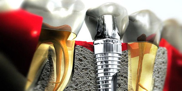 Milletvekillerinin implant hakkı 8'e çıktı