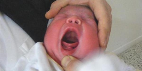 Bebek iki dişli doğdu