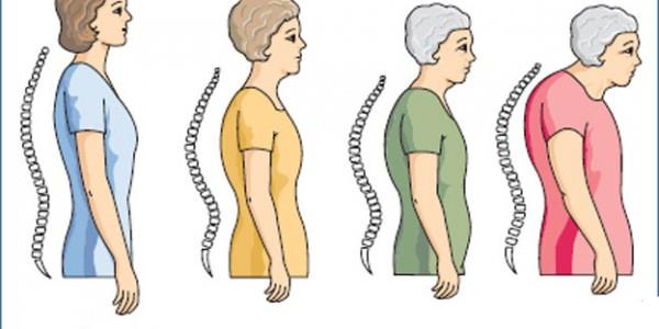 Osteoporoz riski kadınlarda daha fazla