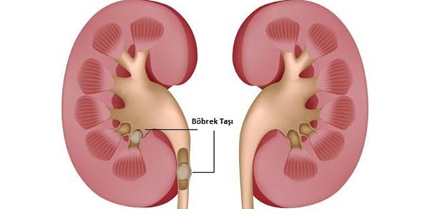 'Elma' tipte bbrekler risk altnda