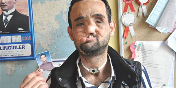 İnegöllü genç yüz nakli olmak istiyor