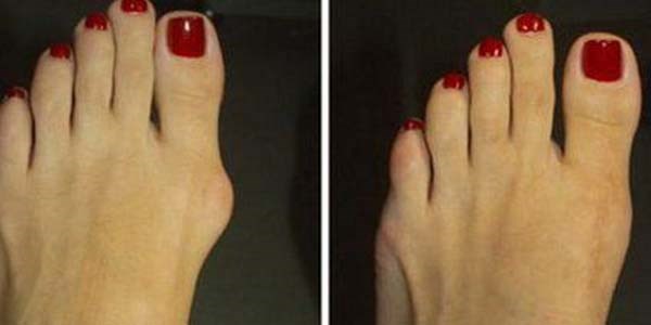 Ba�parmak ��k�nt�s�n�n sorumlusu ayakkab� de�il, 'aile'