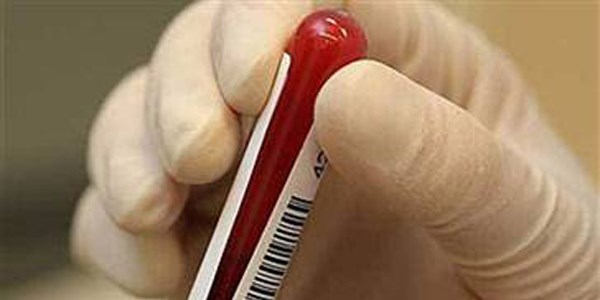 Down sendromuna erken ve kesin test