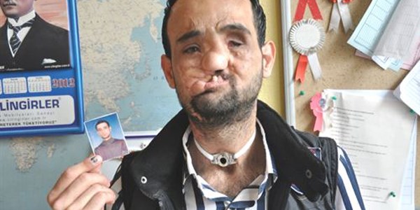 Oğlu yüz nakli olacak babanın dramı