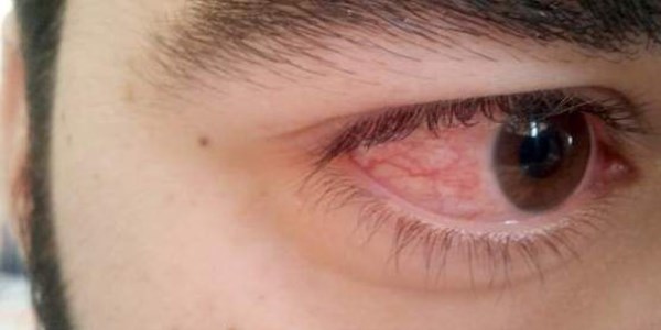 G�z kanlanmas�n� basite almay�n