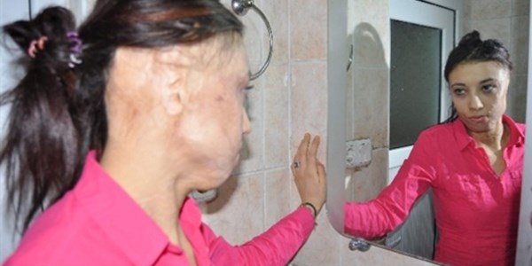 Gaziantepli genç kız yüz nakli olmak istiyor