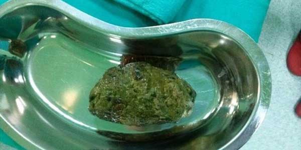 Midesinden yumruk b�y�kl���nde ta� ��kt�