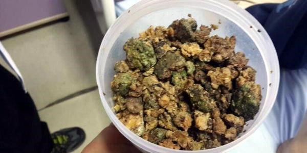 Midesinden 2 kilo yaban hurması çıktı