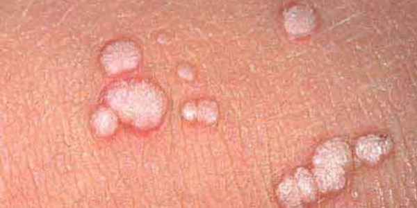 Her 4 kişiden 3'ünde HPV virüsü görülüyor