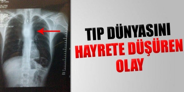 Tıp dünyasını hayrete düşüren olay