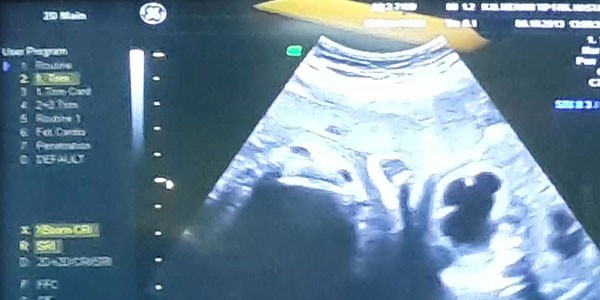 Anne karnındaki bebeğe böbrek ameliyatı