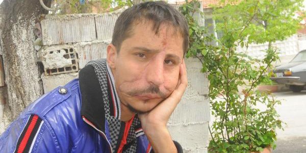Validen, yüz nakli olan gence iş ve eş sözü