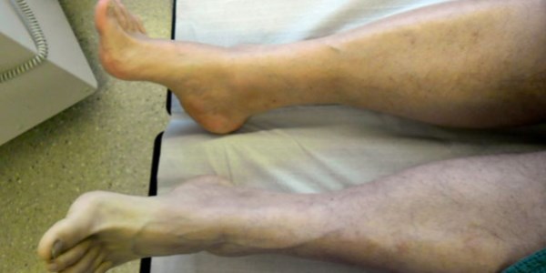 Damar t�kan�kl��� tedavisinde en etkili y�ntem 'Bypass'