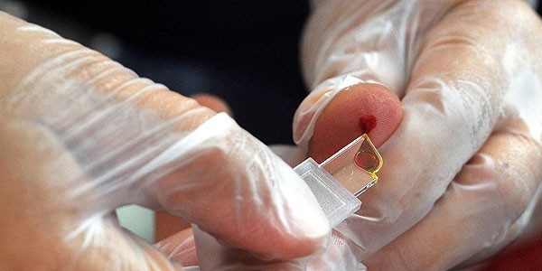 Kistik fibrozise tarama testli çözüm
