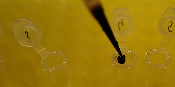 Alzheimer'da erken tan� umudu