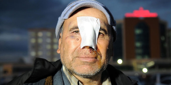 Kesilen buruna 2 gün gecikmeli dikiş atıldı iddiası