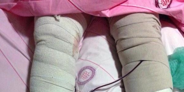 Profesör, menisküs ameliyatını yanlış dize yaptı