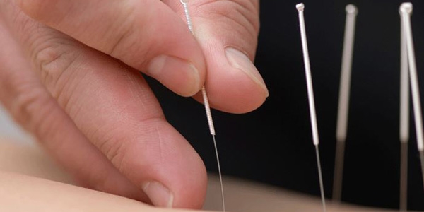 'Kuru iğne' tedavisi ile ağrılara çözüm