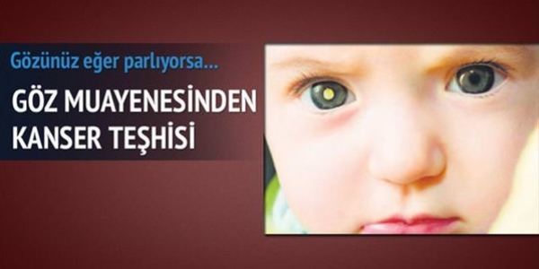 Gözden kanser teşhis edilebiliyor
