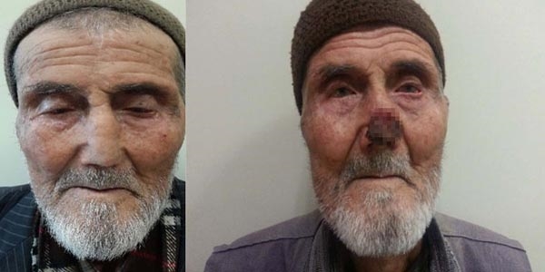 Alnından alınan dokuyla burun yapıldı