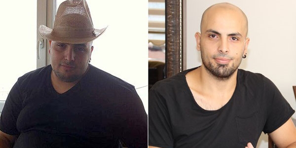 'Gastrik by-pass' ameliyat� ile 90 kilo verdi