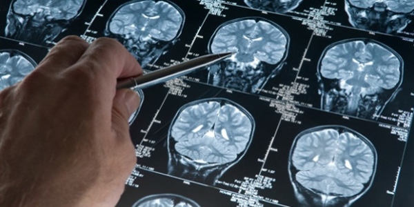 Alzheimer'ı temizleyen molekül bulundu