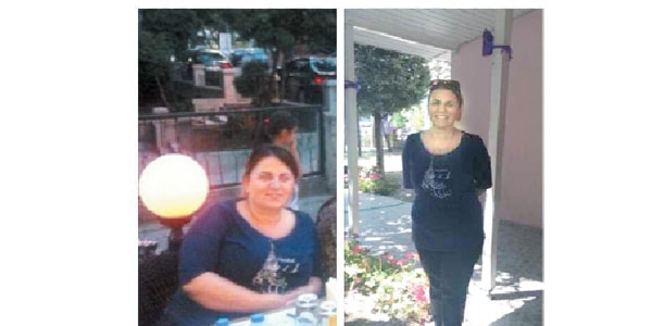 Obezite ameliyatı kişiye özel olmalı
