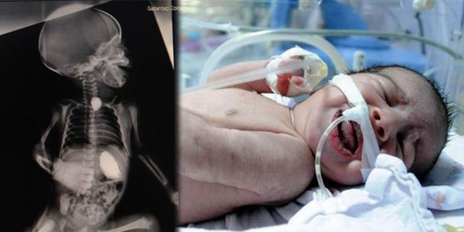 3 g�nl�k bebe�in yemek borusundan ta� ��kt�