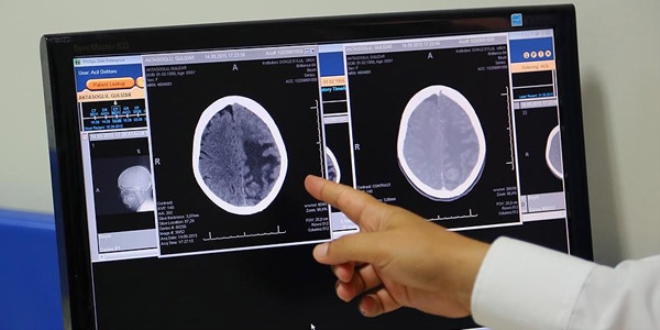 'Beyin damar hastalklar kazalardan iki kat fazla can alyor'