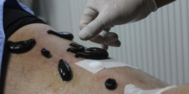 Sülük tedavisinde 'hepatit' uyarısı