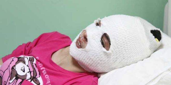 Sallad��� d�d�kl� tencere patlad�, y�z� yand�