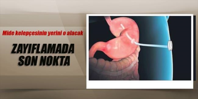 Mide kelepçesi yerine mide tüpü